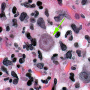 Trophozoite of Acanthamoeba sp. in tissue, stained with hematoxylin and eosin (H&E). Adapted from CDC