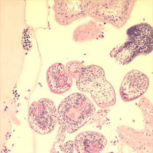 Protoscoleces in a hydatid cyst removed from lung tissue, stained with hematoxylin and eosin (H&E). Image taken at 200x magnification. Image courtesy of Phoenix Children's Hospital, Phoenix, AZ. Adapted from CDC