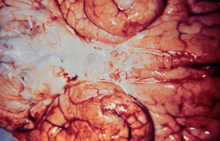 Brain infected with Gram-negative Haemophilus influenzae bacteria From Public Health Image Library (PHIL). [4]