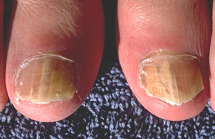 Onychomycosis due to Trychophyton rubrum, right and left great toe.