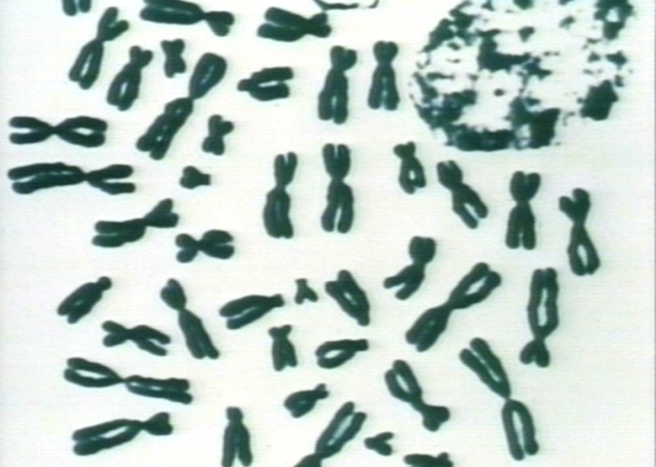 Normal karyotype.