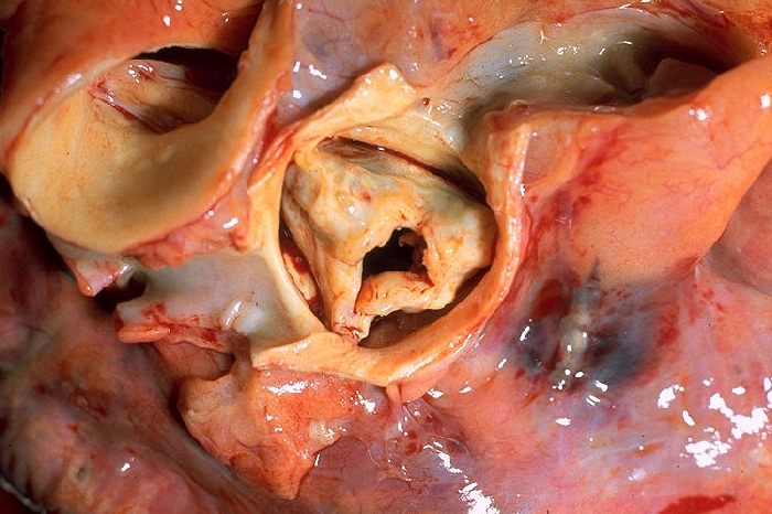 File:Aortic stenosis rotated.jpg