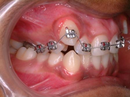 Unilateral cross bite where the maxillary molar is lingual (towards the tongue) than the occluding mandibular molar.