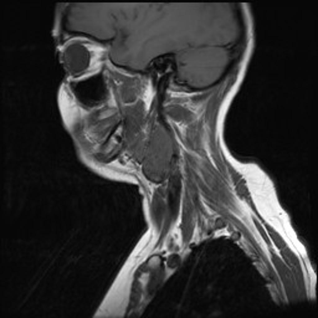 File:Carotid-body-tumour-3.jpg