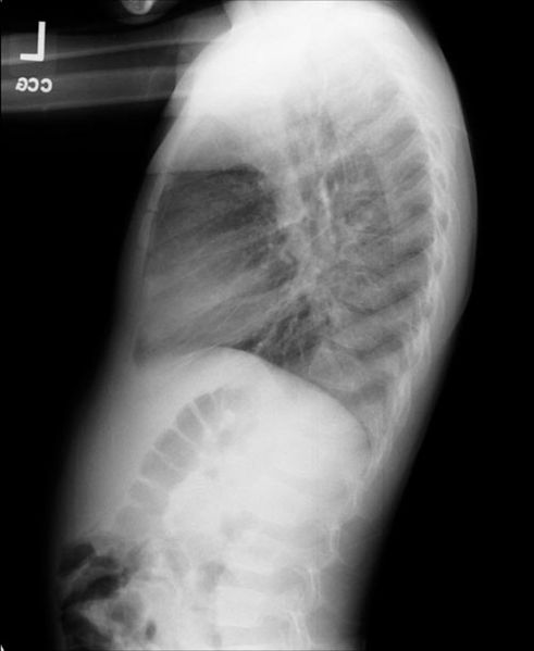 Right lower lobe collapse. The same patient. Lateral view.