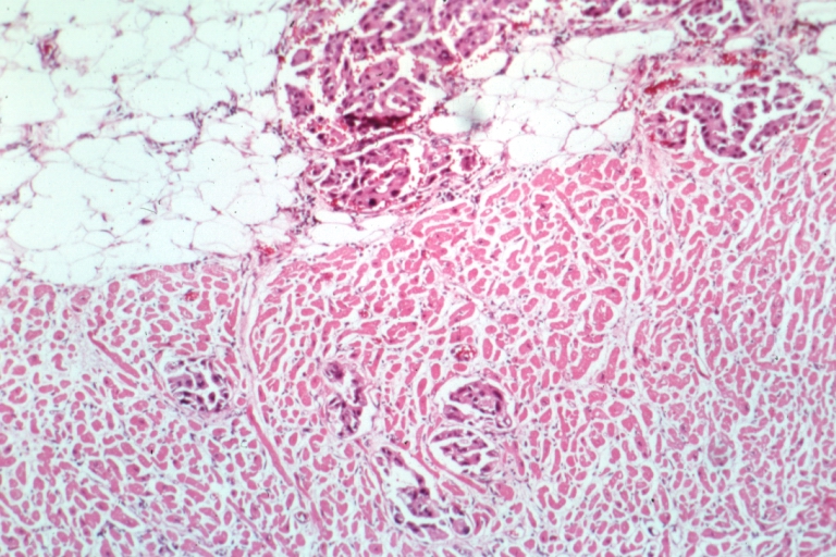 HEART: Metastatic Carcinoma: Micro low mag H&E. Lung alveolar cell carcinoma shows tumor in pericardial fat and into subepicardial myocardium