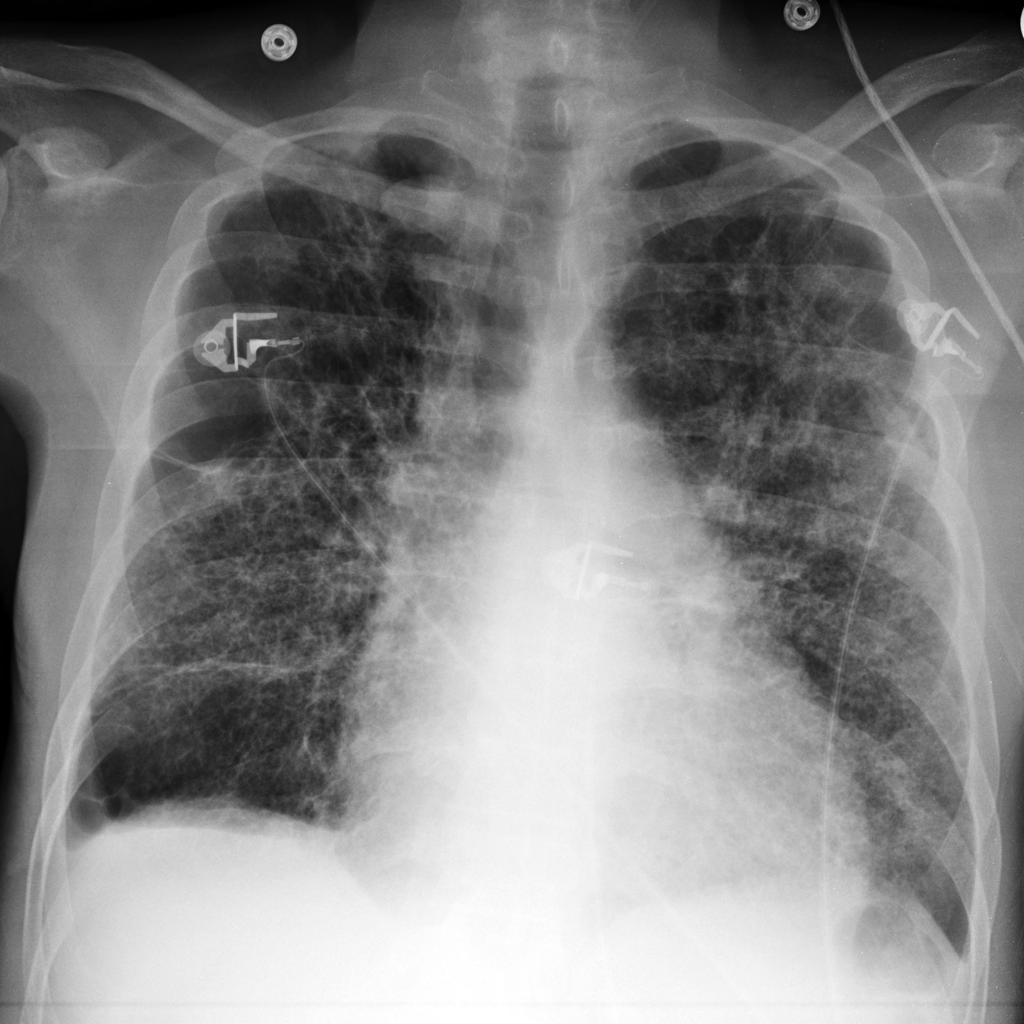 Chest x-ray of a patient demonstrates a rounded opacity in the medial aspect of the right apex
