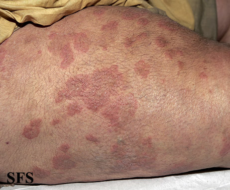 File:Dermatitis herpetiformis38.jpg