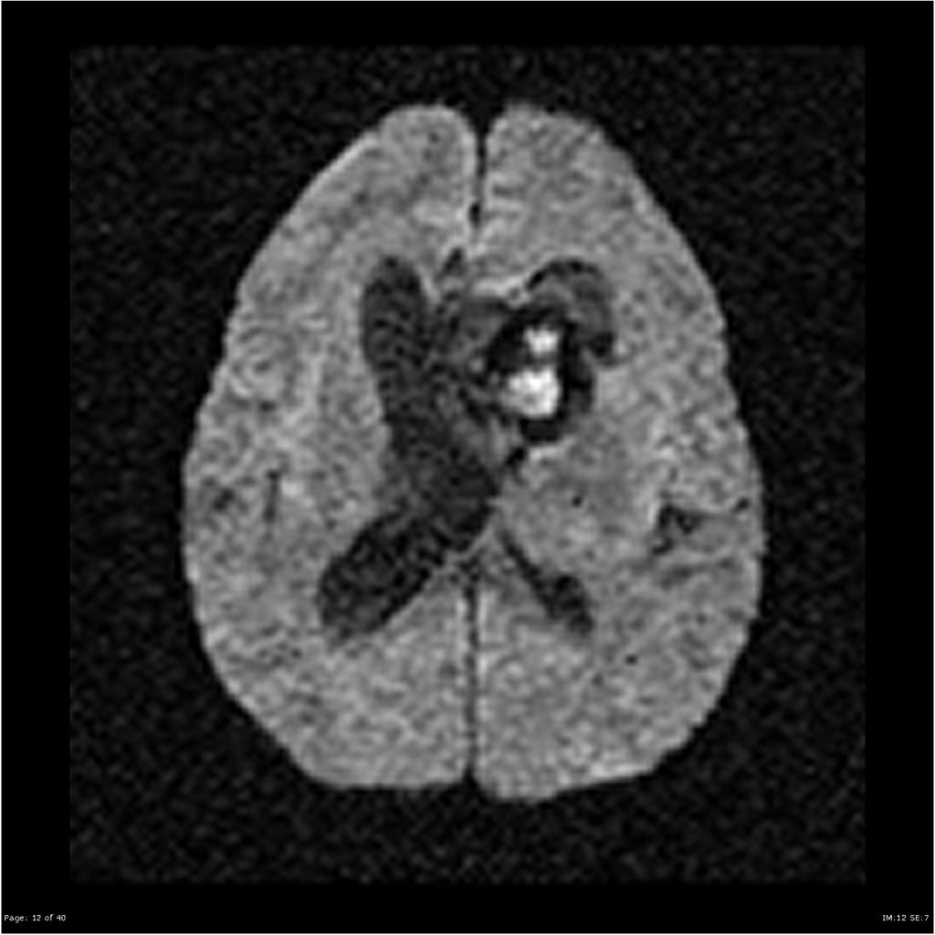 File:Ependymoma-lateral-ventricle(9).jpg