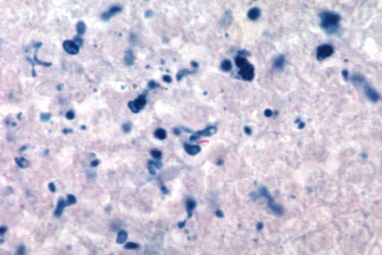 Tuberculous pericarditis: Micro oil acid fast stain. The organism easily seen.