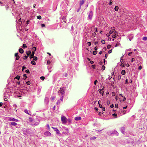 Cysts of P. jirovecii in lung tissue, stained with methenamine silver and hematoxylin and eosin (H&E). The walls of the cysts are stained black; the intracystic bodies are not visible with this stain. Adapted from CDC