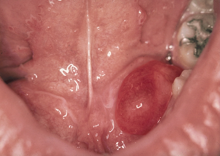 SALIVARY GLANDS: RANULA. This 2.5-cm ranula in the anterior floor of the mouth is not especially large, but it is larger than mucoceles that occur in most other sites.Ranulas are either extravasation type or retention cyst type mucoceles.