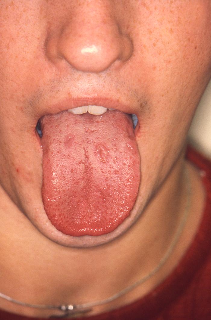 With a VDRL (Venereal Disease Research Laboratory) titer of 1:128, this syphilis patient displayed symptoms indicative of the onset of the secondary stage of this disease, which included generalized lymphadenopathy, and accompanying lingual (tongue) mucous patches. Syphilis is a sexually transmitted disease (STD) caused by the bacterium Treponema pallidum. It has often been called "the great imitator" because so many of the signs and symptoms are indistinguishable from those of other diseases. It is passed from person to person through direct contact with a syphilis sore. Sores occur mainly on the external genitals, vagina, anus, or in the rectum. Sores also can occur on the lips and in the mouth. Transmission of the organism occurs during vaginal, anal, or oral sex. Pregnant women with the disease can pass it to the babies they are carrying. Syphilis cannot be spread through contact with toilet seats, doorknobs, swimming pools, hot tubs, bathtubs, shared clothing, or eating utensils. Adapted from CDC