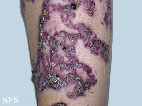 Angiokeratoma Circumscriptum. Adapted from Dermatology Atlas.<ref name="Dermatology Atlas">{{Cite