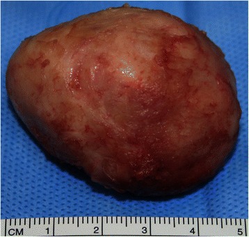File:Cardiac fibroma gross.jpg