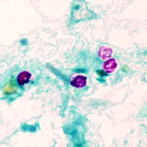 Cryptosporidium parvum oocysts stained with modified acid-fast. Against a blue-green background, the oocysts stand out in a bright red stain. Sporozoites are visible inside the two oocysts to the right in this image. Adapted from CDC