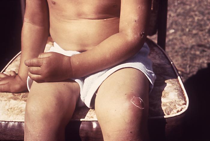Imaculopapular lesions that proved to be impetigo, a bacterial skin infection. From Public Health Image Library (PHIL). [5]