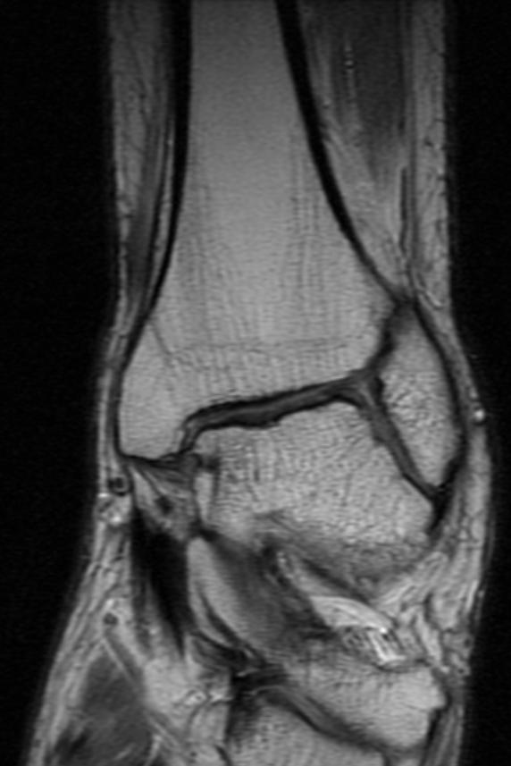 File:Hemophilia ankle MRI 105.jpg