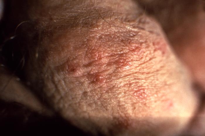 This patient presented with what was diagnosed as a herpes genitalis outbreak on the penile shaft due to HSV-2. Genital herpes is a sexually transmitted disease caused by the herpes simplex viruses type 1 (HSV-1), and type 2 (HSV-2). Most genital herpes is caused by HSV-2. Symptoms typically include one or more blisters on or around the genitals or rectum. Adapted from CDC