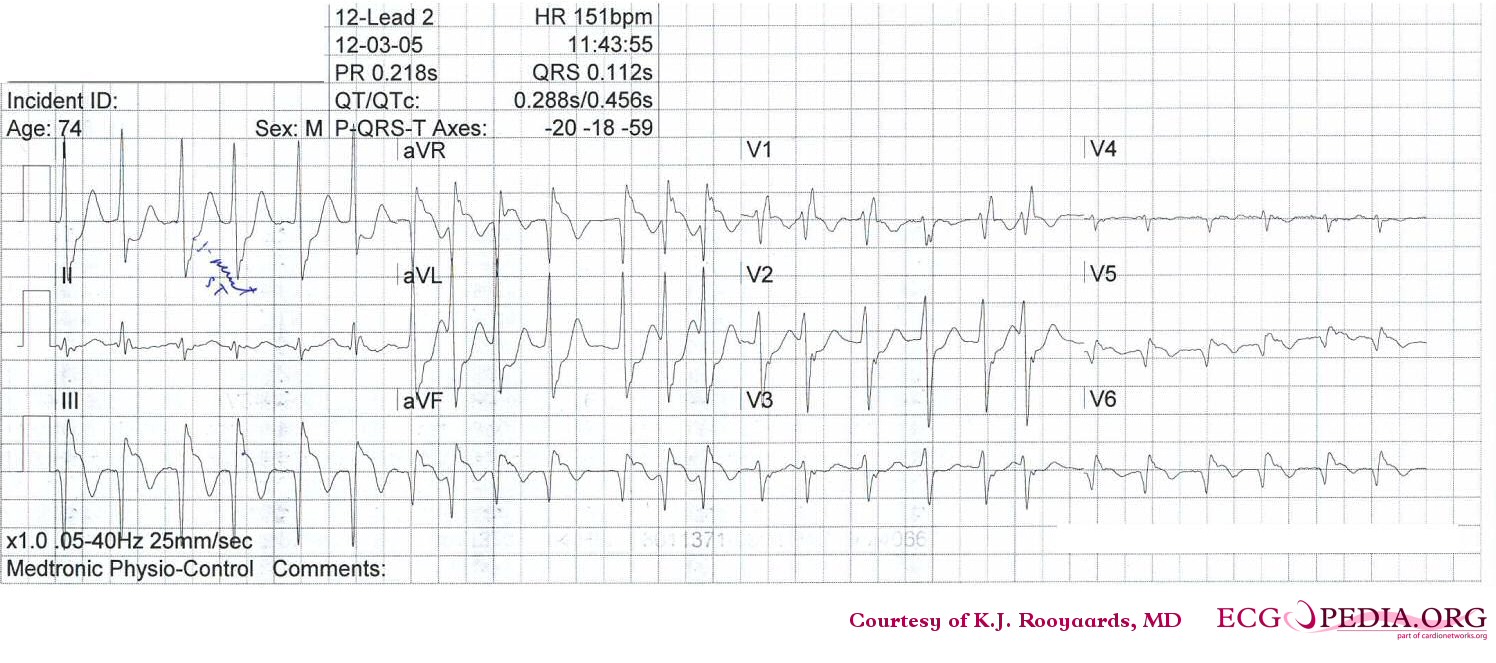 Atrial fibrillation with inferior-posterior-lateral myocardial infarction and incomplete right bundle branch block. Lead I shows ST depression, suggestive of right coronary artery involvement.