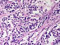 File:120px-Adrenal Neuroblastoma HP CTR.jpg