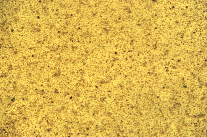 Under a low magnification of 12.5X, this photomicrograph reveals McCoy cell monolayers with Chlamydia trachomatis inclusion bodies. Chlamydia, caused by Chlamydia trachomatis, is the most common bacterial sexually transmitted infection. Using cell cultures from the McCoy cell line is one methods implemented in diagnosing Chlamydial infections. Adapted from CDC