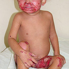 File:Acrodermatitis enteropathica 09.png