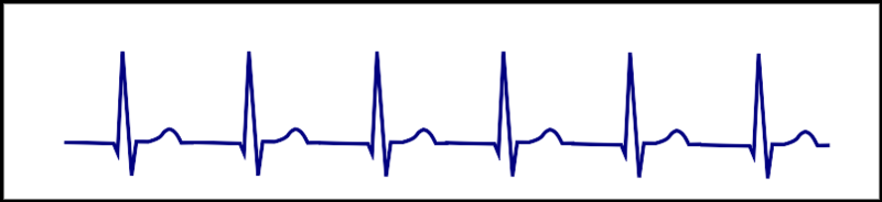 AV junctional tachycardia - no or inverted p-waves within QRS complex