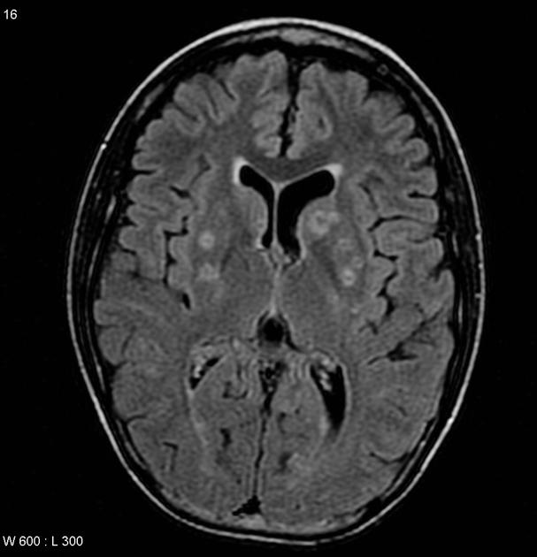 File:MRI HIV Toxoplasmosis 2.jpg