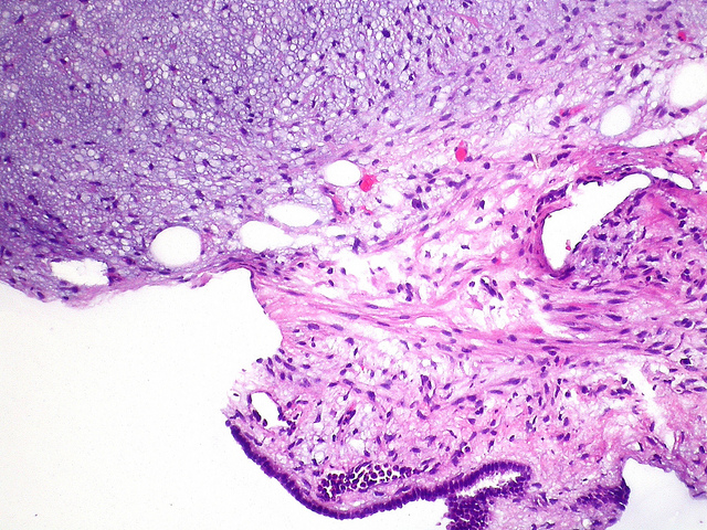 Epithelial lined clefts within myxoid fibrous connective tissue.[7]