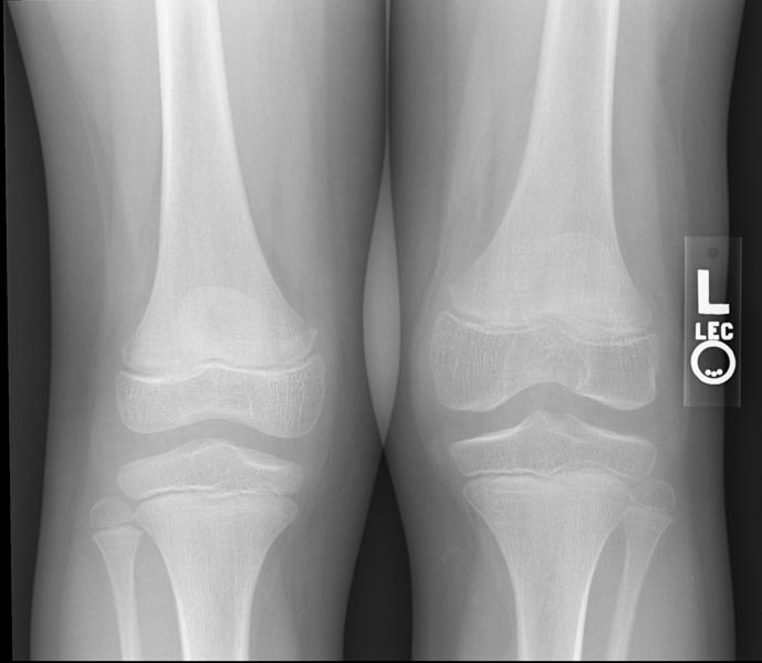 Hemophilic arthropathy involving the bilateral knees