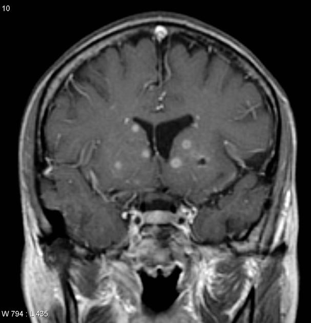 File:MRI HIV Toxoplasmosis.jpg