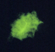 Direct immunofluorescence antibody stain using monoclonal antibodies that target Pneumocystis jirovecii. This image is from a bronchoalveolar lavage (BAL) specimen from a patient with a malignancy. Image courtesy of Brigham & Women's Hospital, Boston, MA. Adapted from CDC