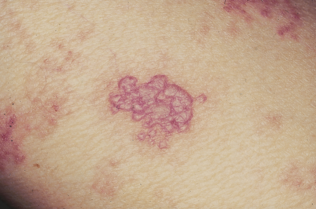 Herpes Zoster. (Courtesy of Josh Fierer, M.D. and Charlie Goldberg, M.D.)