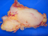 Follicular lymphoma replacing a lymph node.