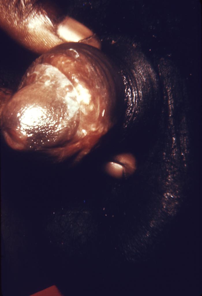 This patient presented with a penile lesion, which under darkfield microscopic examination was found to be due to syphilis. The primary stage of syphilis is usually marked by the appearance of a single sore known as a chancre, but there may be multiple sores. The chancre is usually firm, round, small, and painless. Adapted from CDC
