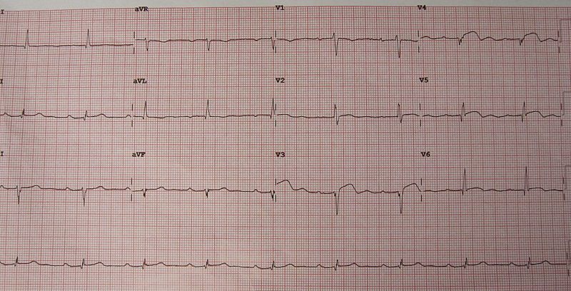 An ECG of a person with a left ventricular aneurysm. Note the ST elevation in the anterior leads.