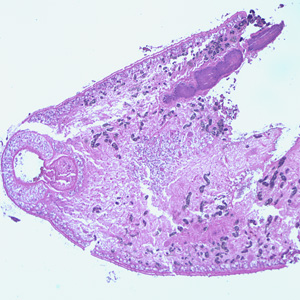 Adult of Paragonimus sp., taken from a lung biopsy specimen stained with hematoxylin and eosin (H&E). Note the presence of the oral sucker. The species was not identified in this case. Adapted from CDC