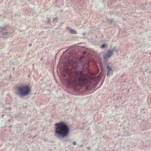 Cyst of B. mandrillaris in brain tissue, stained with H&E. Image courtesy of the University of Kentucky Hospital, Lexington, Kentucky. Adapted from CDC