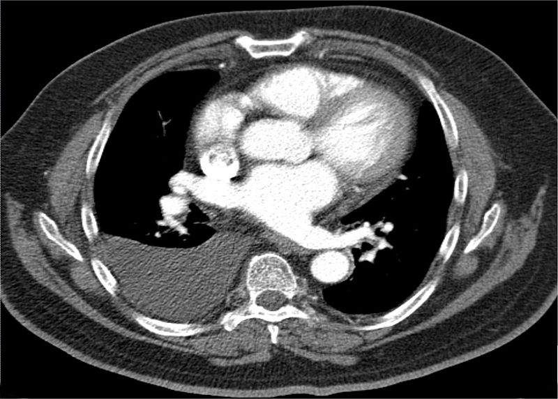 File:CT image right side pleural effusion.jpg