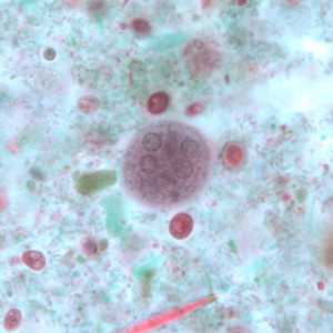Mature cyst of E. coli, stained with trichrome. These two images represent the same cyst shown in two different focal planes. Eight nuclei can be seen between the two focal planes. Also, above the cyst in the first image, a trophozoite of Endolimax nana can be seen