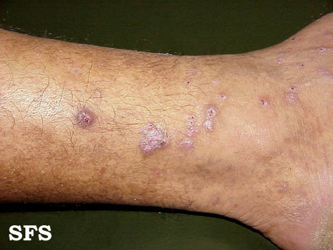 Prurigo nodularis. With permission from Dermatology Atlas.[9]