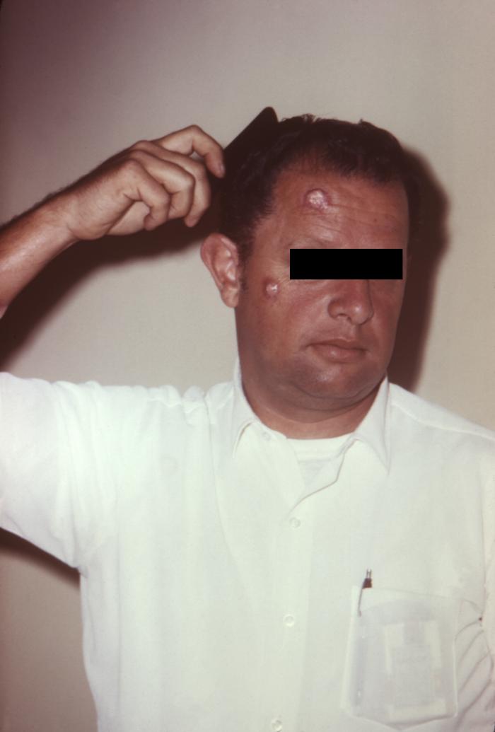 "Symptoms of cutaneous anthrax due to B. anthracis.”Adapted from Public Health Image Library (PHIL), Centers for Disease Control and Prevention.[3]
