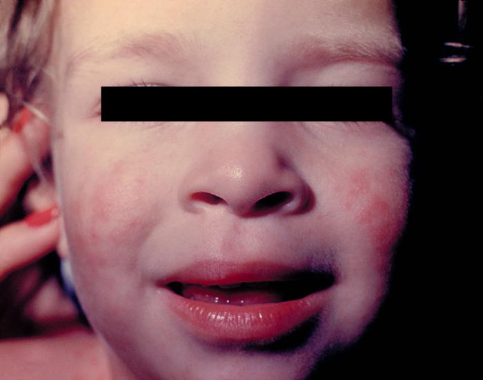 Girl with skin lesions on the face due to echovirus type 9. From Public Health Image Library (PHIL). [27]