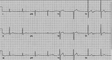 Tall T waves in V1 seen in Left bundle branch block and left ventricular hypertrophy