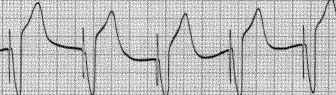 Ventricular paced rhythm shows ventricular pacemaker spikes