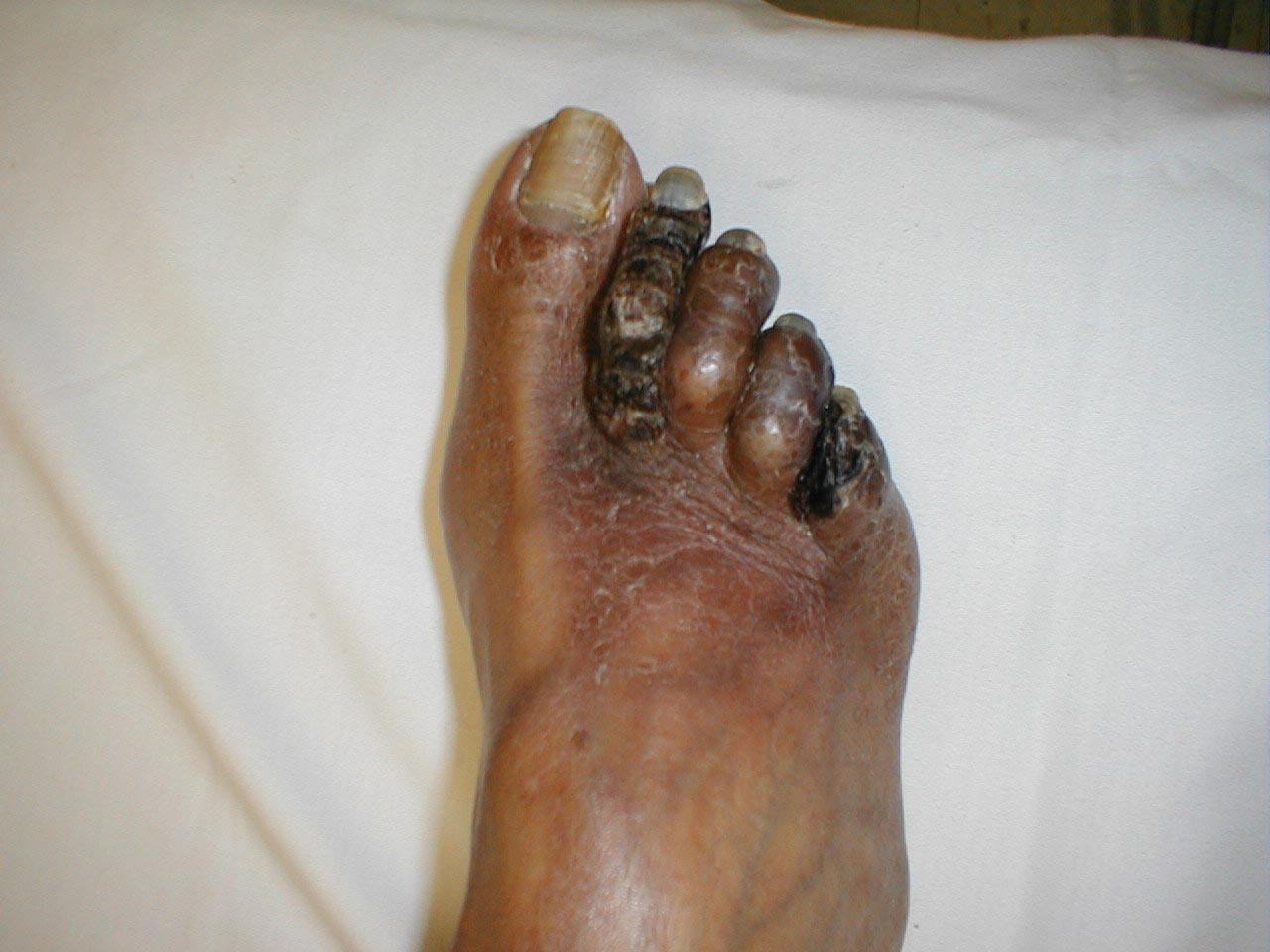 Gangrene of Toes