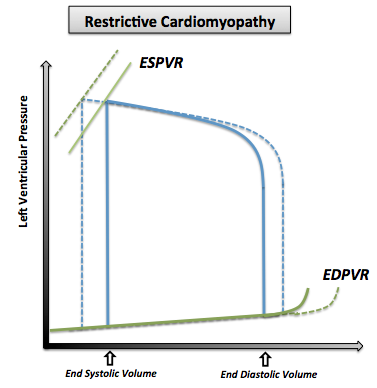 File:Restrictive Cardiomyopathy.png