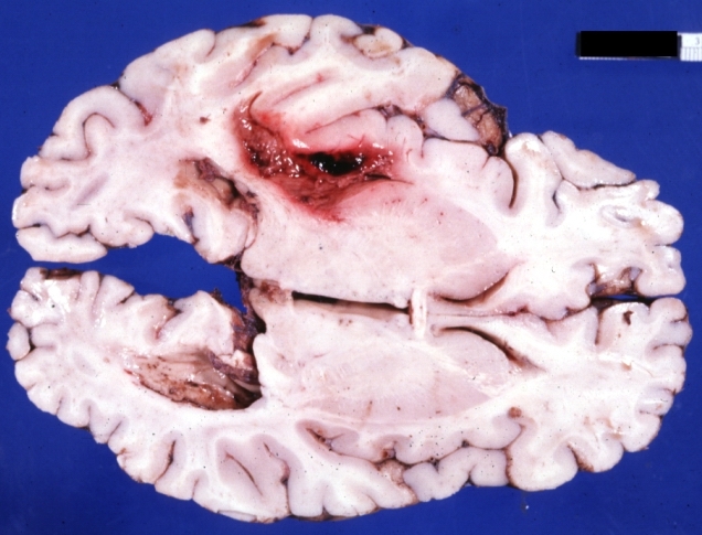 Brain: Hemorrhage Massive With Lupus Erythematosus: Gross apparently fresh tissue large left frontoparietal hemorrhagic infarct in a 16yo female with advanced lupus nephritis and sepsis