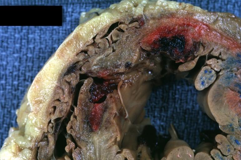 Acute MI, rupture of the ventricular septum. A close up view.
